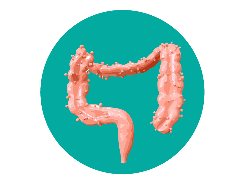 Diverticulosis