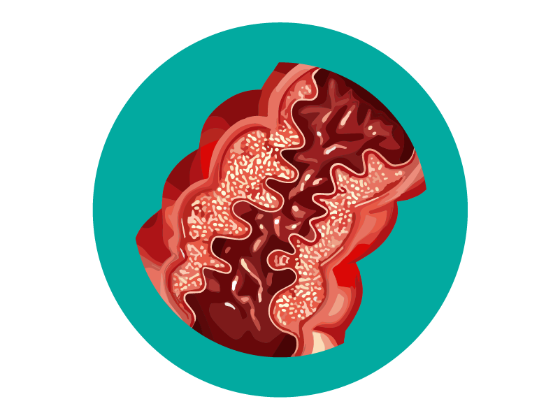 Enfermedad de Crohn