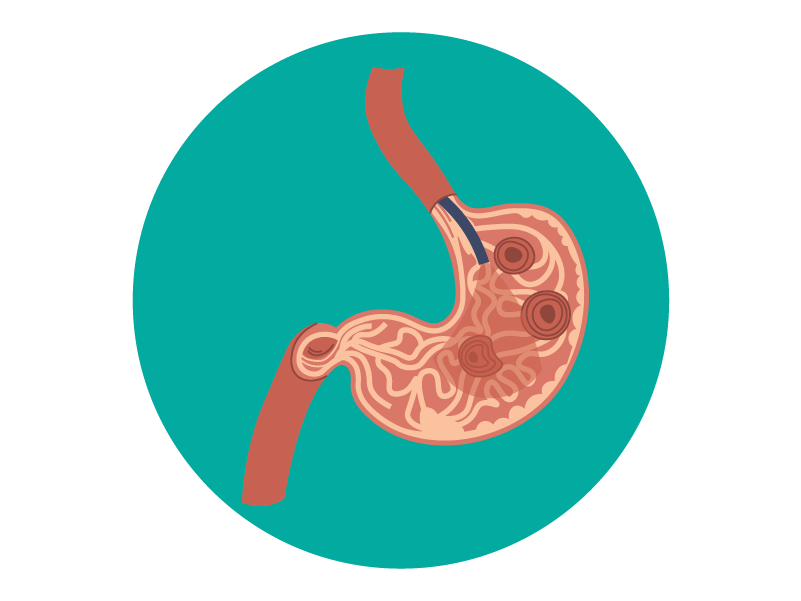 Úlcera gástrica, duodenal y péptica